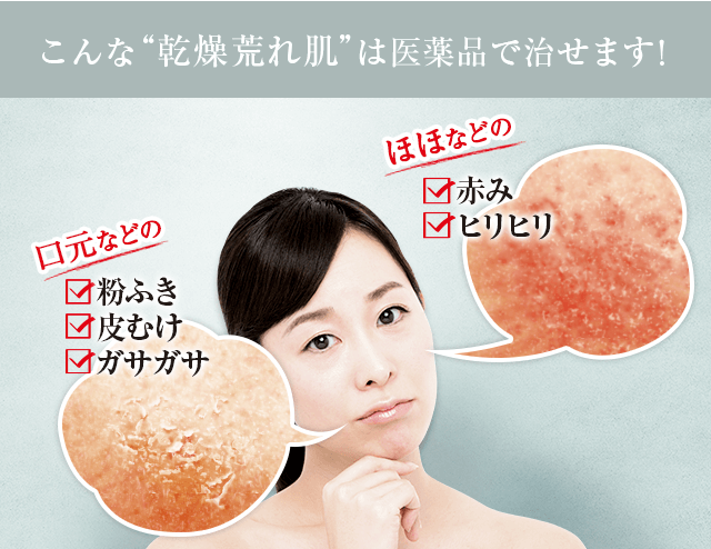 こんな乾燥荒れ肌は医薬品で治せます！