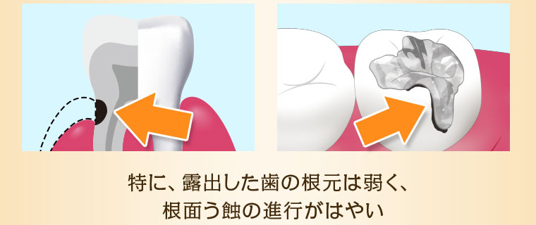 特に、露出した歯の根元は弱く、根面う蝕の進行がはやい
