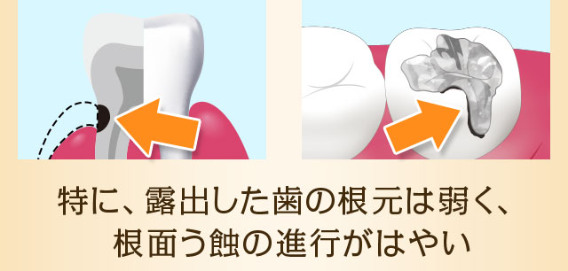 特に、露出した歯の根元は弱く、根面う蝕の進行がはやい