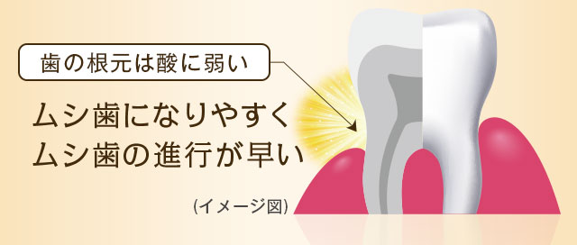 歯の根元は酸に弱い