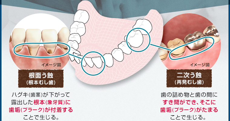 すき間ができ、そこに歯垢(プラーク)がたまる