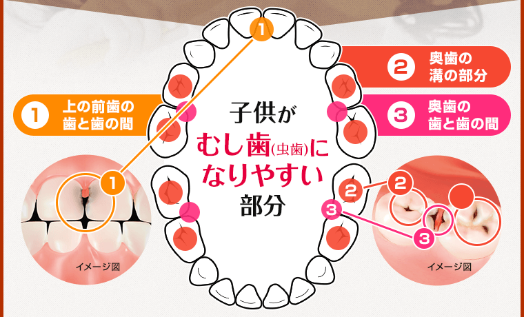 子供がむし歯(虫歯)になりやすい部分