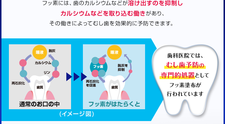 歯科医院では、むし歯予防の専門的処置として