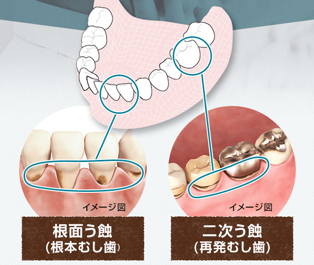 根面う蝕(根本むし歯)