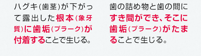 根本(象牙質)に歯垢(プラーク)が付着することで生じる。