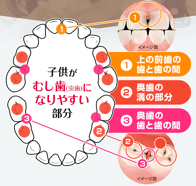 子供がむし歯(虫歯)になりやすい部分