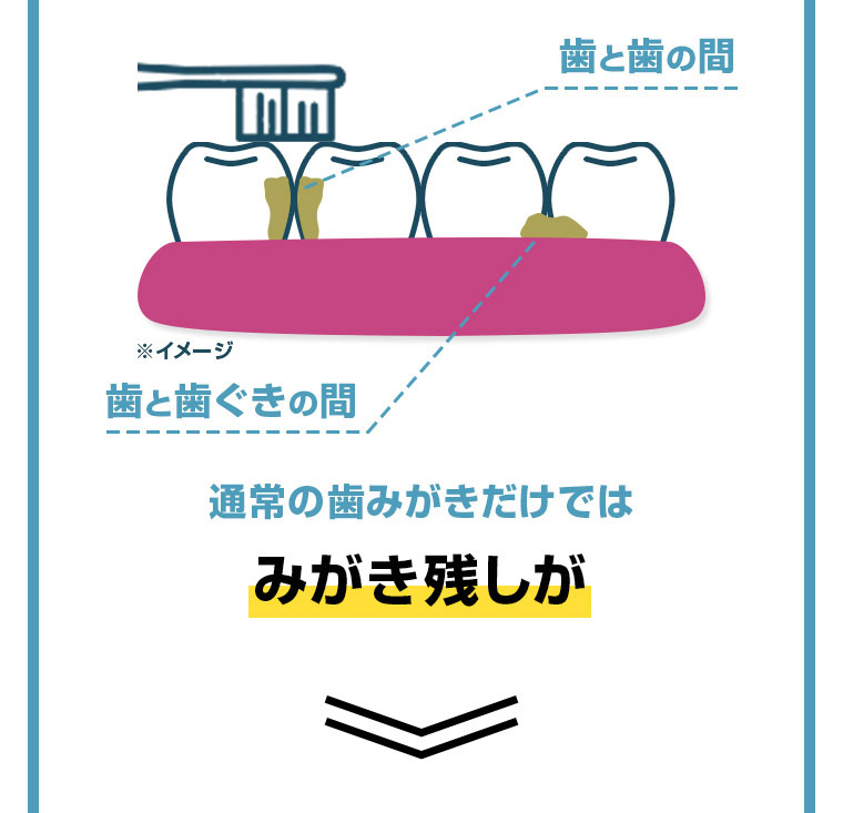 通常の歯みがきだけではみがき残しが