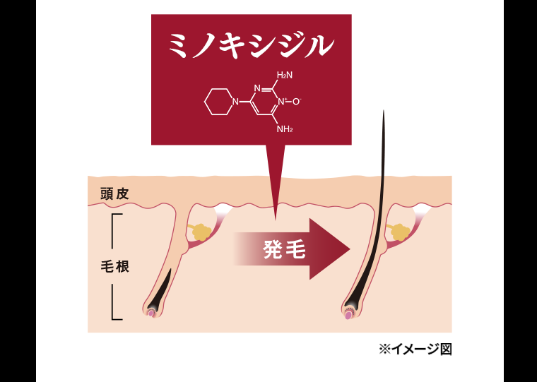 ミノキシジル