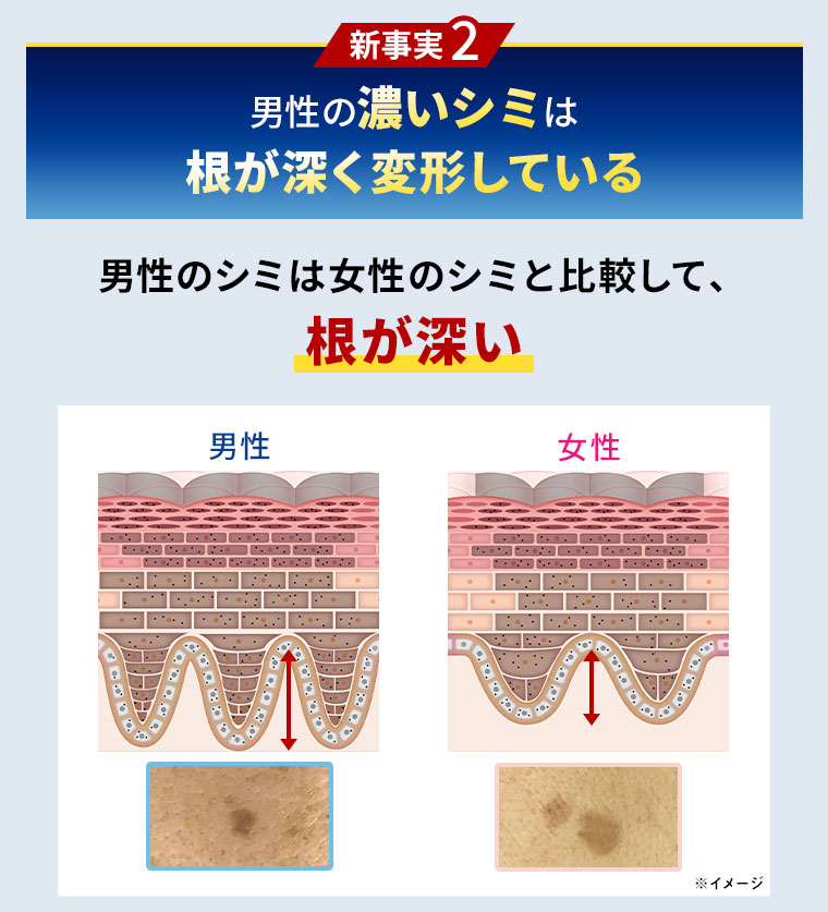 新事実2　男性の濃いシミは根が深く変形している