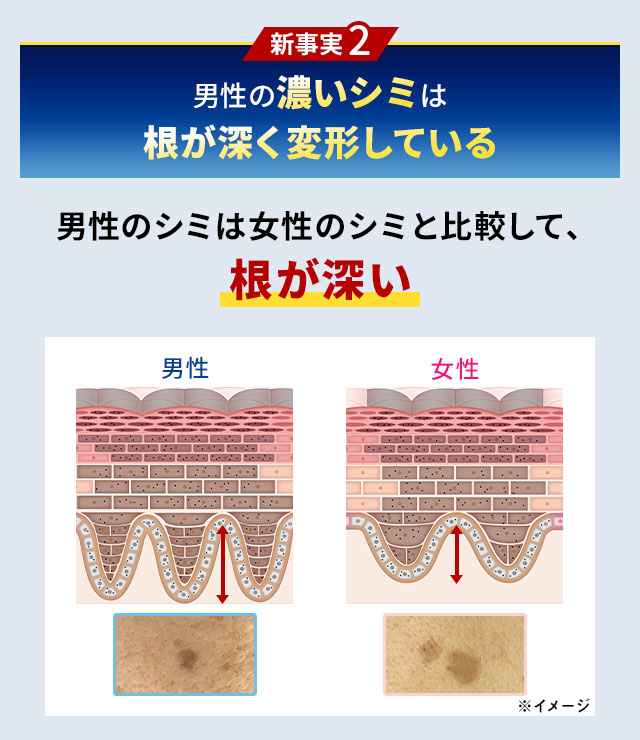 新事実2　男性の濃いシミは根が深く変形している