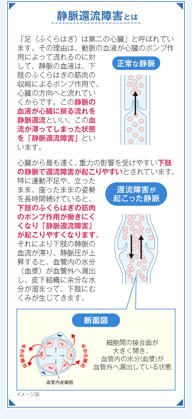 静脈還流障害とは