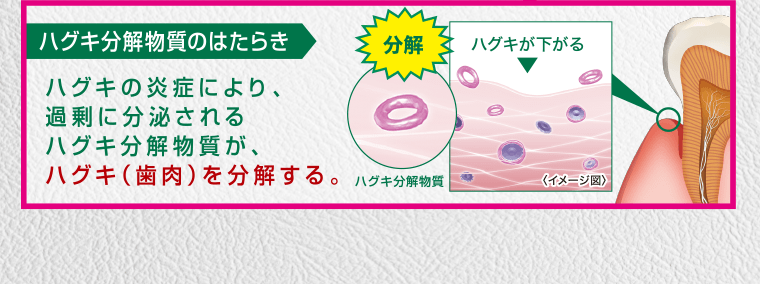 ハグキ分解物質のはたらき　ハグキの炎症により、過剰に分泌されるハグキ分解物質が、ハグキ（歯肉）を分解する。
