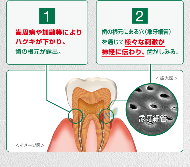 【1】歯周病や加齢等によりハグキが下がり、歯の根元が露出。【2】歯の根元にある穴（象牙細管）を通じて様々な刺激が神経に伝わり、歯がしみる。