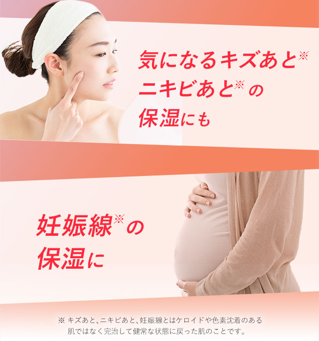 気になるキズあとニキビあとの保湿にも　妊娠線の保湿に