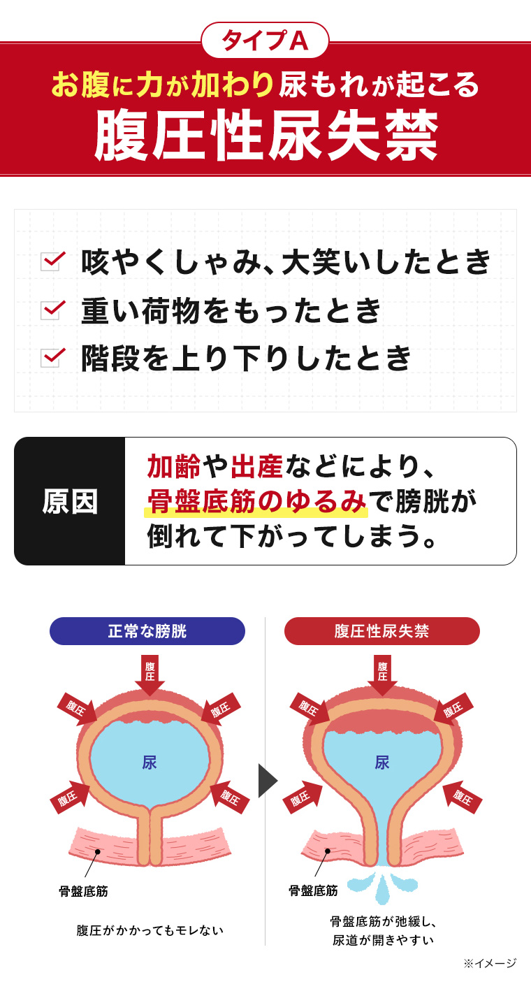 タイプA お腹に力が加わり、尿もれが起こる腹圧性尿失禁