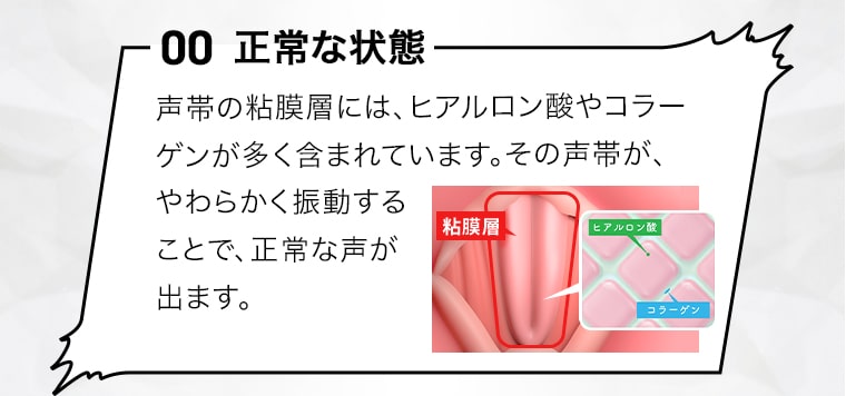 【正常な状態】声帯の粘膜層には、ヒアルロン酸やコラーゲンが多く含まれています。その声帯が、やわらかく振動することで、正常な声が出ます。