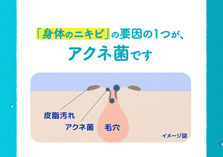 「身体のニキビ」の要因の１つが、アクネ菌です