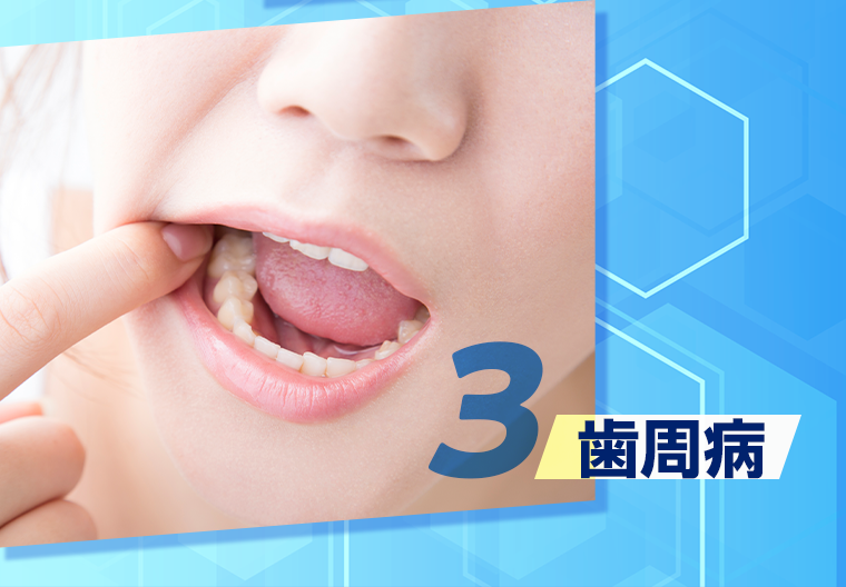 ３　歯周病