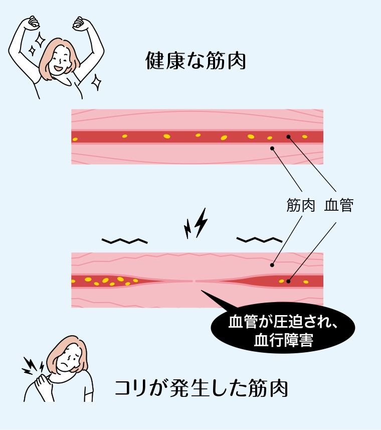 血管が圧迫され、血行障害