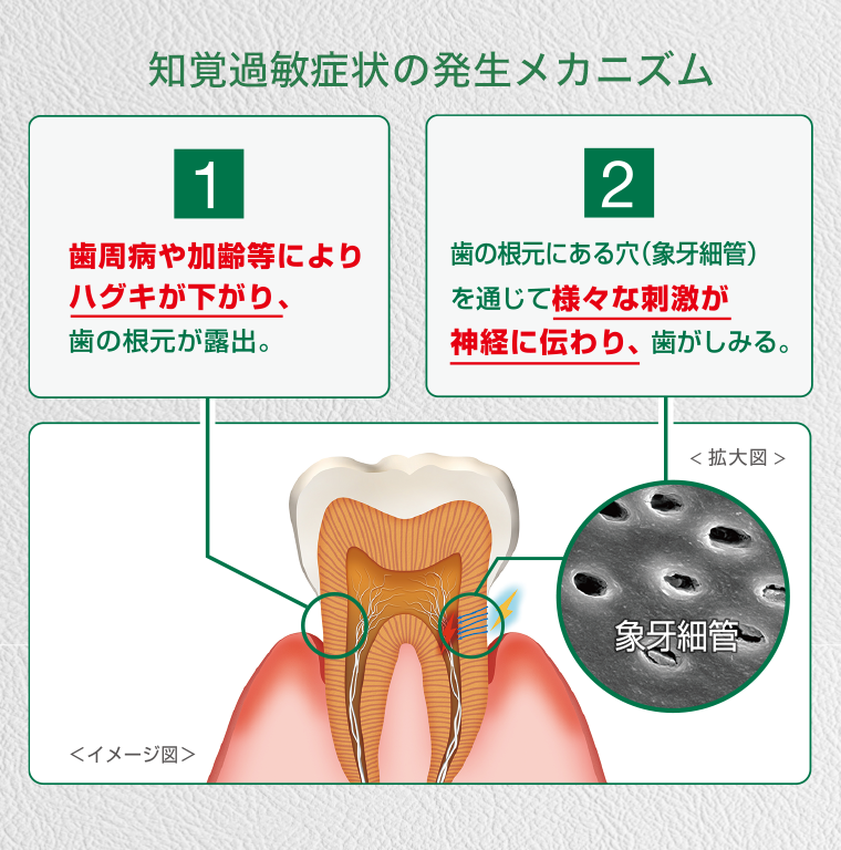 知覚過敏症状の発生メカニズム