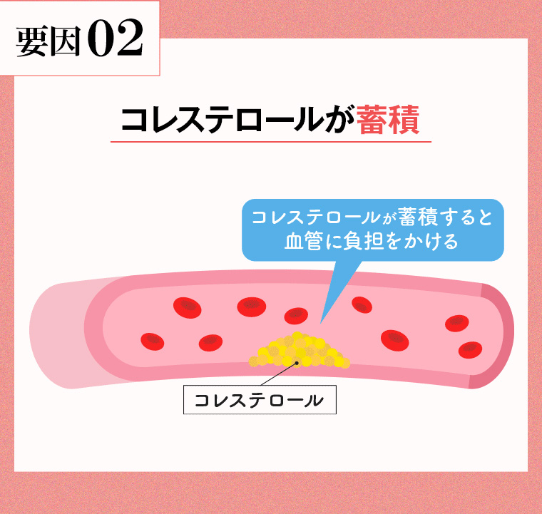 要因 02 コレステロールが蓄積 コレステロールが蓄積すると血管に負担をかける