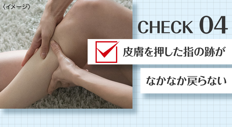 CHECK 04 皮膚を押した指の跡がなかなか戻らない