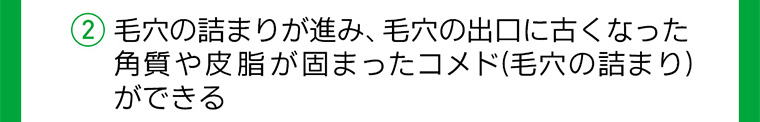 2 毛穴の詰まりが進み、 毛穴の出口に古くなった角質や皮脂が固まったコメド (毛穴の詰まり)ができる