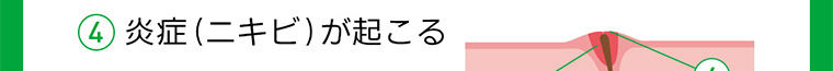 4 炎症(ニキビ)が起こる