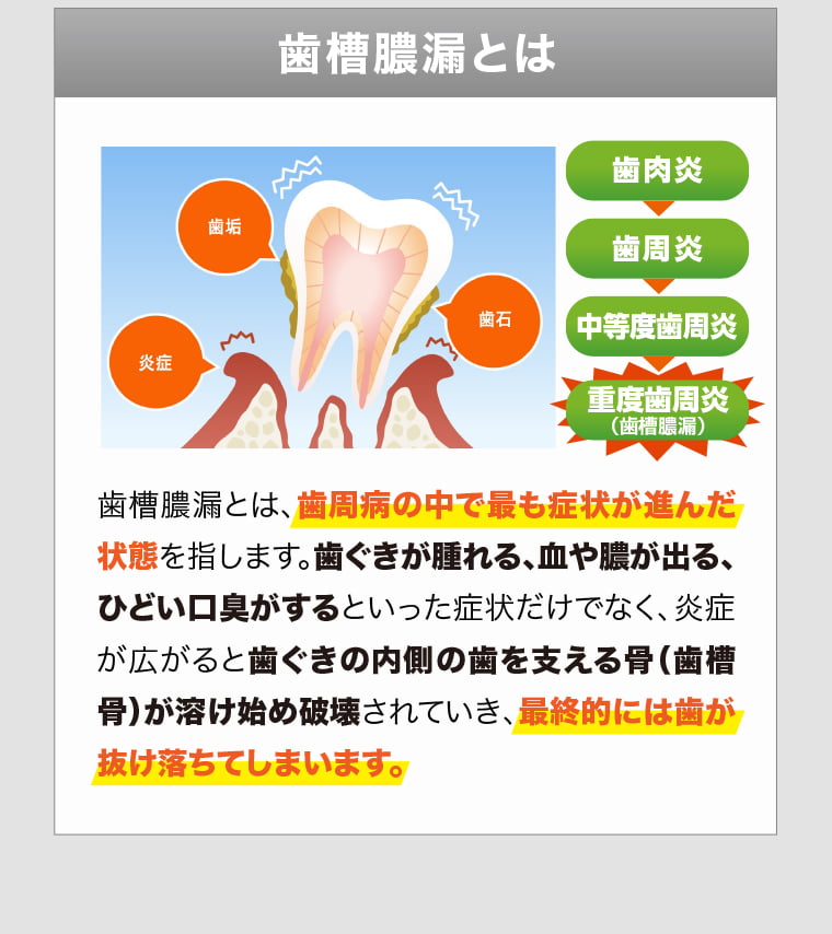 歯槽膿漏とは、歯周病の中で最も症状が進んだ状態を指します