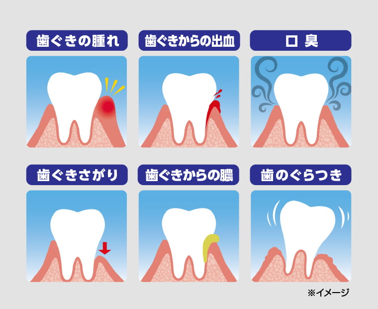 歯ぐきの腫れ、歯ぐきからの出血、口臭、歯ぐきさがり、歯ぐきからの膿、歯のぐらつき