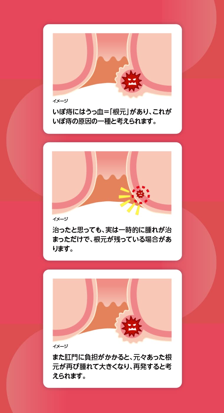 いぼ痔にはうっ血＝「根元」があり、これがいぼ痔の原因の一種と考えられます。治ったと思っても、実は一時的に腫れが治まっただけで、根元が残っている場合があります。また肛門に負担がかかると、元々あった根元が再び腫れて大きくなり、再発すると考えられます。