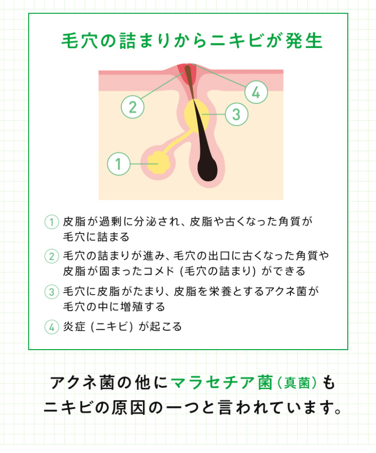 毛穴の詰まりからニキビが発生