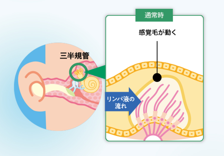 【通常時】頭を動かすと、ともにリンパ液が動いて体のバランスを感知しています（平衡機能）。