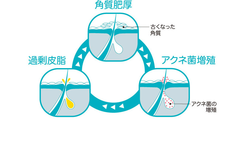毛穴の詰まり図