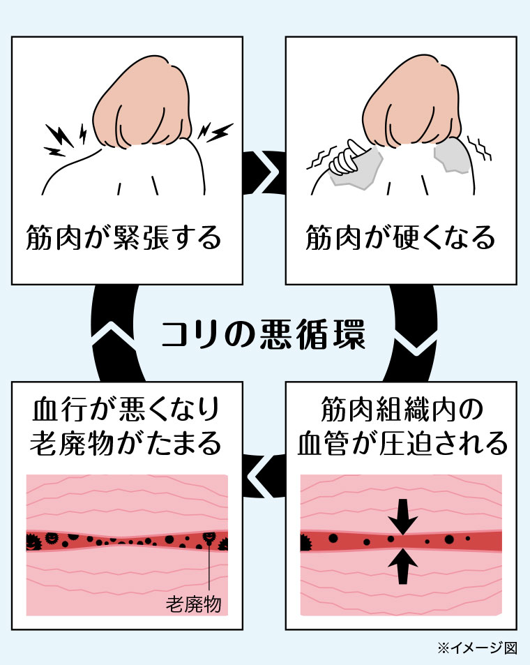 コリの悪循環。筋肉が緊張する。筋肉が硬くなる。筋肉組織内の血管が圧迫される。血行が悪くなり老廃物がたまる。イメージ(本画像をご確認ください)。