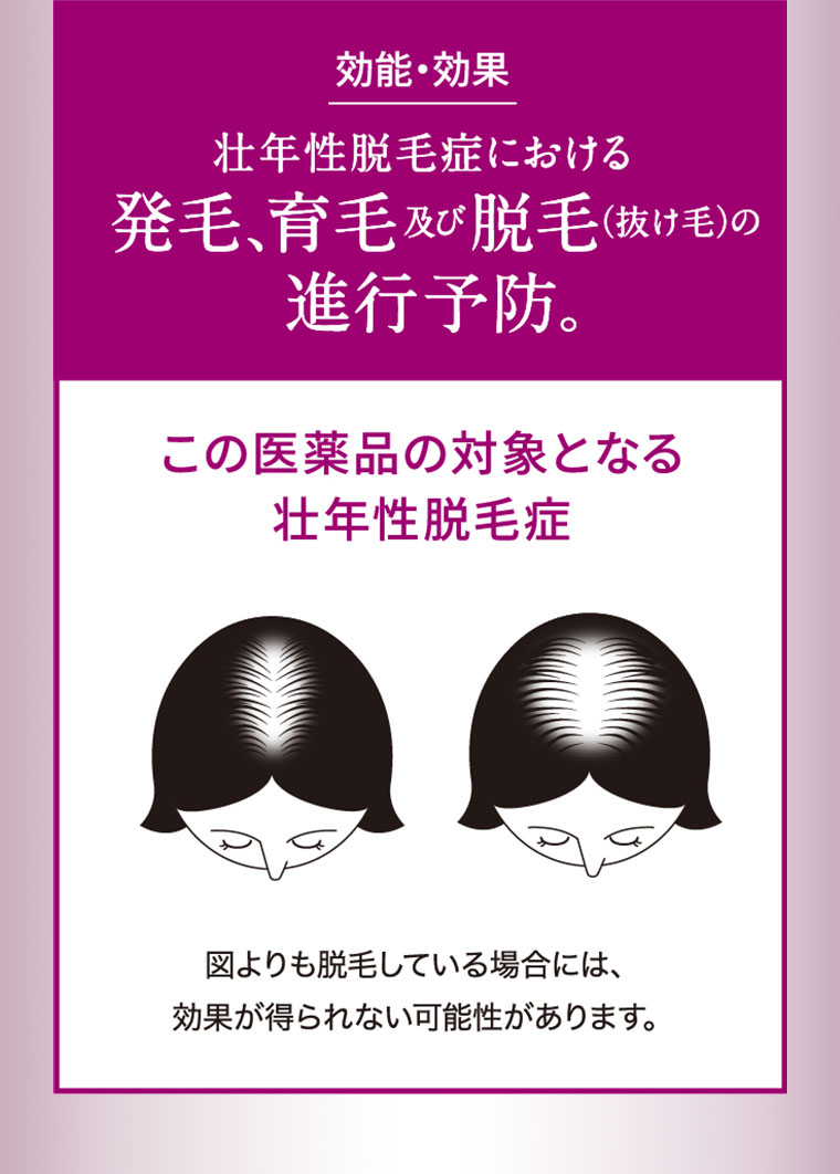 効能・効果。壮年性脱毛症における発毛、育毛及び脱毛(抜け毛)の進行予防。この医薬品の対象となる壮年性脱毛症。図(本画像をご確認ください)。図よりも脱毛している場合には、効果が得られない可能性があります。