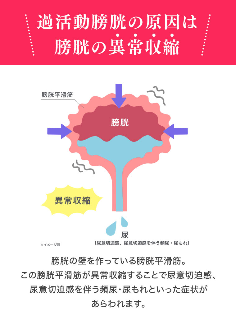 過活動膀胱の原因は膀胱の異常収縮。図（本画像をご確認ください）。膀胱の壁を作っている膀胱平滑筋。この膀胱平滑筋が異常収縮することで尿意切迫感、尿意切迫感を伴う頻尿・尿もれといった症状があらわれます。
