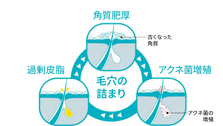 毛穴の詰まり　図解